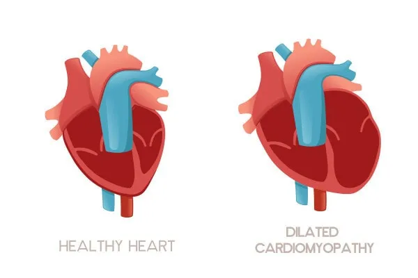 Comparison diagram showing a healthy dog heart next to a heart affected by dilated cardiomyopathy